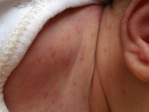 4个月的宝宝有湿疹,有什么办法