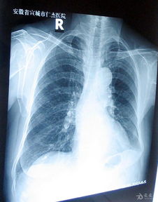 请帮张肺部x片,如图 谢谢