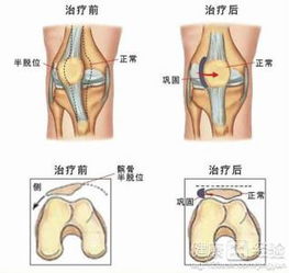 髌骨关节炎的锻炼方法