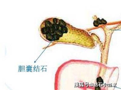 导致胆囊结石病发的几个关键因素,大部分人都中了第一条,别不信