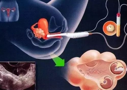 子宫内差影响胚胎着床吗，会有好的试管妊娠结局吗？