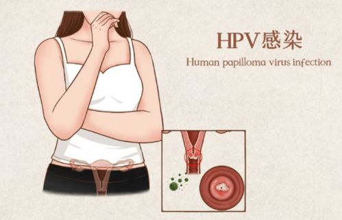 高危型hpv52用药多久后可以复查(高危型hpv52用药多久后可以复查)