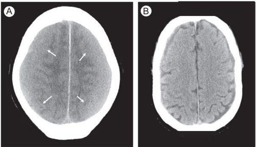 脑出血影像学的9大 陷阱 ,稍不留神就会误诊