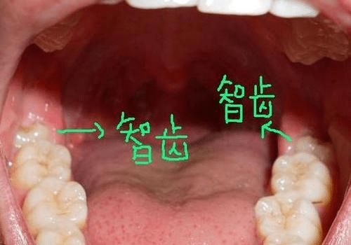 古人也长智齿,为什么从来没听说过古人拔智齿呢