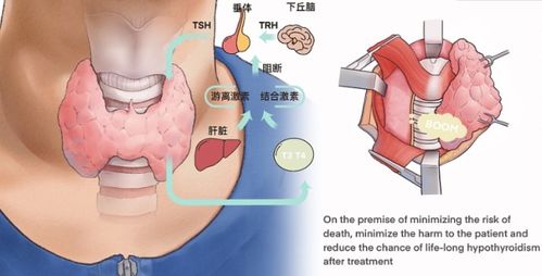 桥本氏甲状腺炎的四大饮食禁忌,每一条都很重要