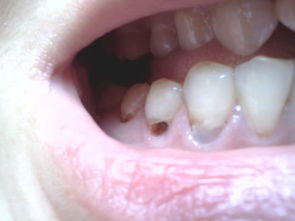 补的牙齿两天就掉了,在补还要磨牙吗 