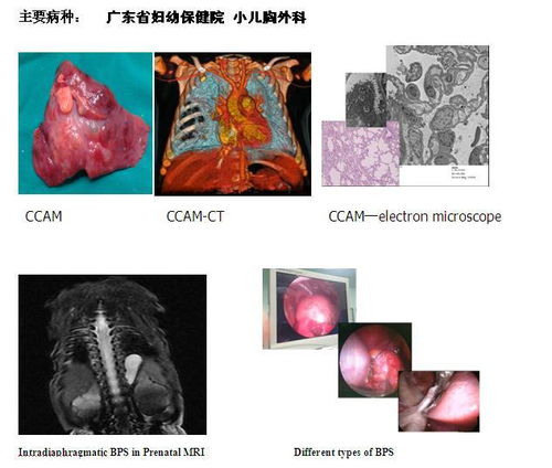 叶内型隔离肺,要不要手术