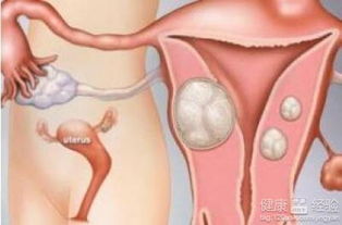 子宫肌瘤如何食疗