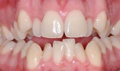 怀化牙博士口腔告诉您 牙龈萎缩到底有多可怕