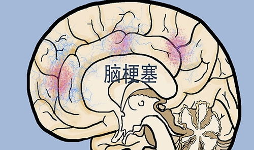 脑梗突发,生命迹象仅需21秒就会消失 两个方法,尽早察觉脑梗