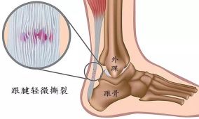 刘翔病 是怎么一回事儿