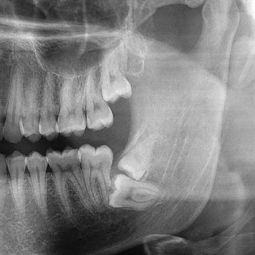 普通牙疼医生为啥让我拍X光 这辐射伤不伤身体呀 