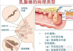 乳腺癌有什么不可以吃(乳腺癌患者不可以吃什么)