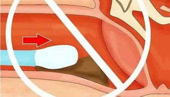 用棉花棒掏耳朵可引发永久性伤害 99 的人都不懂