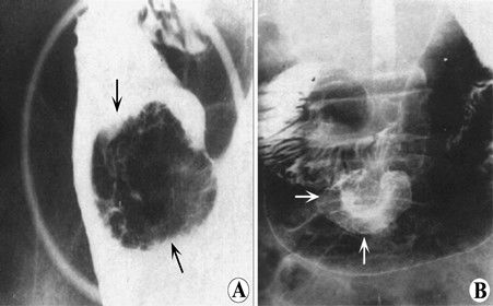 胃癌的X线表现