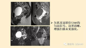 双侧卵巢边缘均见多枚小囊性暗区是病吗 (暗区突围胸骨)