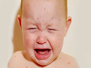婴儿为什么有长湿疹,婴儿为什么长湿疹