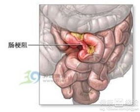 肠梗阻手术，肠梗阻需要做手术么