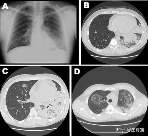 阿根廷北部不明原因肺炎被证实为军团菌感染,这是一种什么细菌