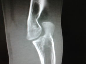 左肘关节骨折畸形愈合,大家看看手术方案怎么做比较好 骨科与显微外科专业讨论版 爱爱医医学论坛 
