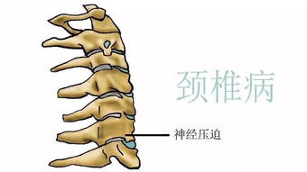 颈椎压迫神经的症状表 图片搜索