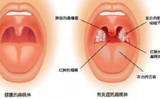 梦见扁桃体发炎发烧(梦见扁桃体肿了很大)