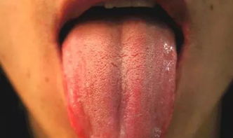 舌头发黄是什么原因 舌苔发黄有什么解决方法 