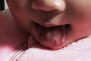 我的女儿周岁舌头上长了白色一圈一圈的 