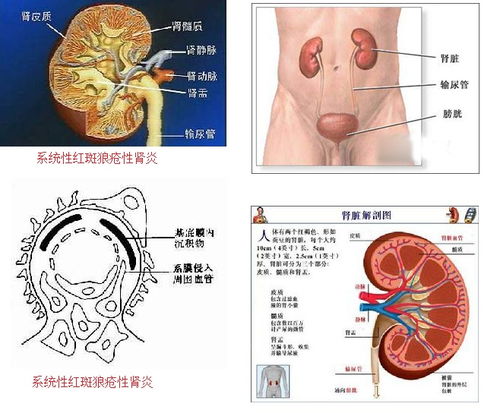 「中重度系膜增生型IGA腎病伴局灶節段硬化 」需怎麼樣治療