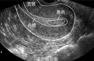 试管过程，内膜长了“息肉”宫腔镜可以检查吗？