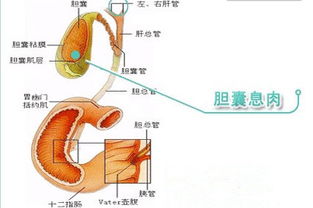 胆囊息肉会变小吗