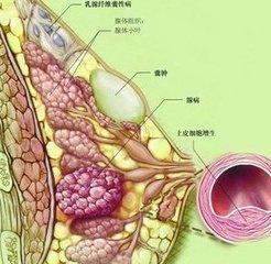 女人得了乳腺结节该怎么办 经常吃3物 多做这4事,可以得到缓解 乳腺疾病 增生 治疗 网易订阅 