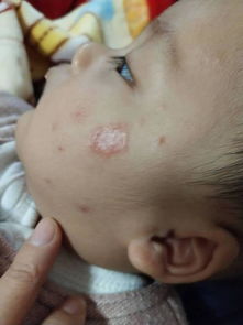 新生儿湿疹图片(宝宝湿疹的图片)
