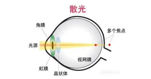 晶视达视力 散光日常保健,这5个方法很有用