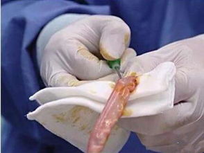 什么情况才做脐血穿刺，胎儿脐带血穿刺对胎儿的影响