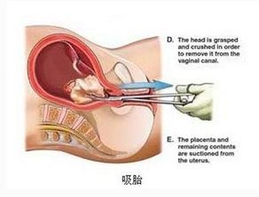 打胎 打胎有几种方式