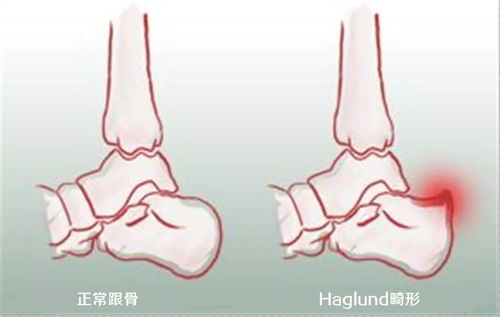 穿鞋老磨脚,真是鞋子的问题吗