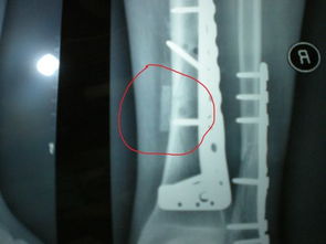 骨折钢板固定术后X光片发现不明物体 