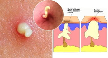 人的脸上为什么会有黑头和粉刺