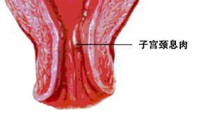 子宫息肉是不是一定要割掉 宫颈息肉是不是一定要割掉呢