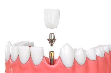 种植牙手术是不是很恐怖 种牙的过程痛苦吗