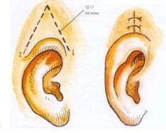 全耳再造能够再造孩子的听力吗
