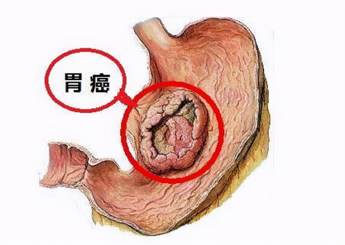 胃癌手术后饮食成困惑 娇弱 的胃作不得,中医食疗成 最佳辅助