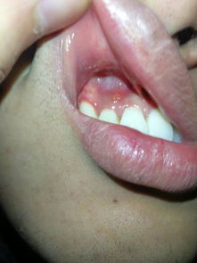 牙龈前面长出小泡 