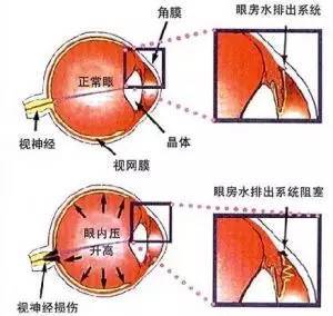 广东靓仔眼睛难受治了3年没见好,竟然是因为这个 这些事很多人都会忽视 