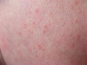 过敏性湿疹怎样根治不复发 苦瓜配上 它 涂抹,轻松搞定湿疹