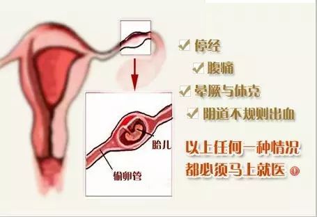 宫外孕症状早期(初期宫外孕的症状)