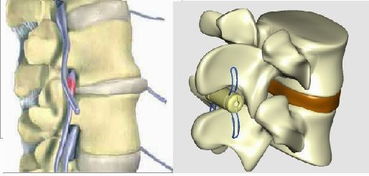 颈椎管狭窄疼的早期症状,颈椎间管狭窄的症状？