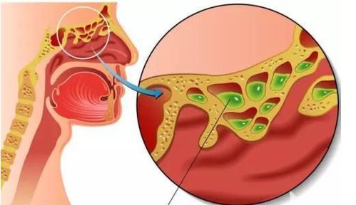 总是鼻塞 流涕 头痛,难道是鼻窦炎发作