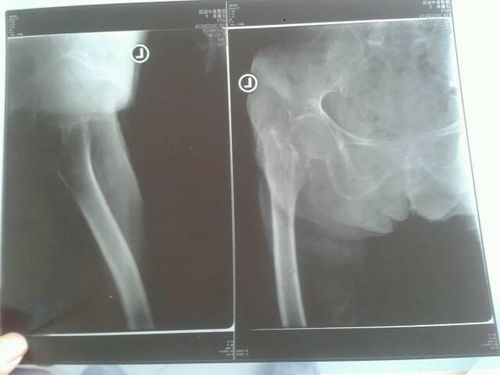 医生您好 请问下老人家股骨颈骨折在家打牵引治疗四个月了,到今天还不能走路,拍X片看到骨痂己生长,但 